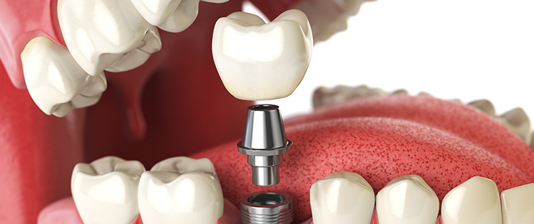 Illustration of a dental implant