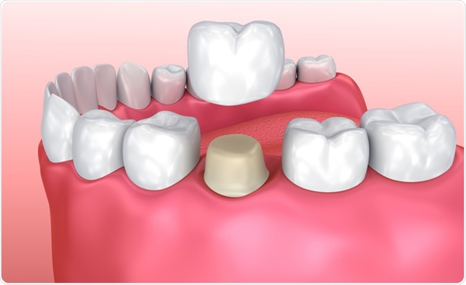 Illustration of a dental crown