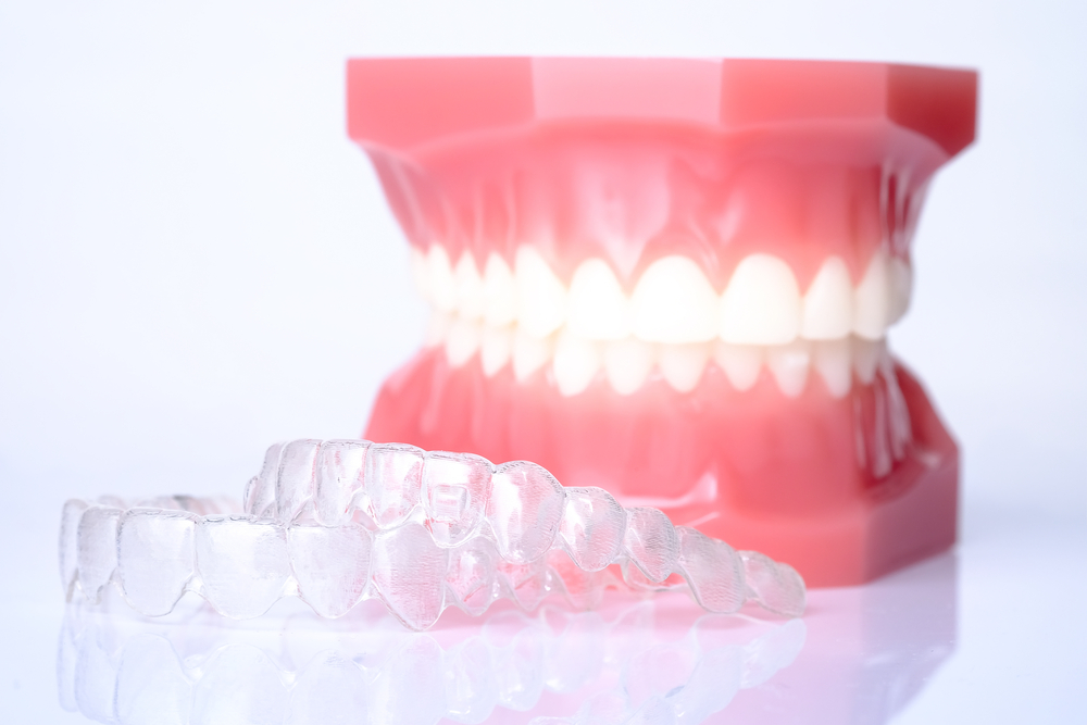 Illustration of a dental implant